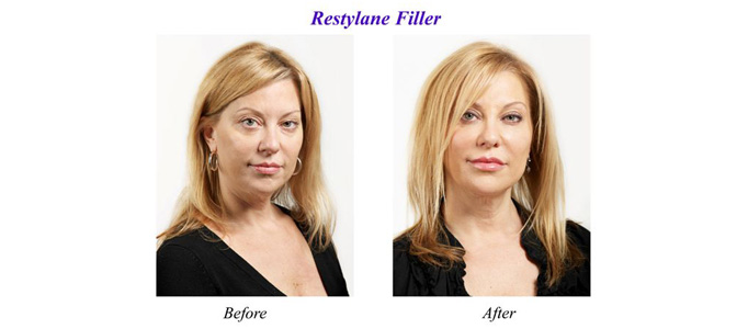 Lip Enhancement
