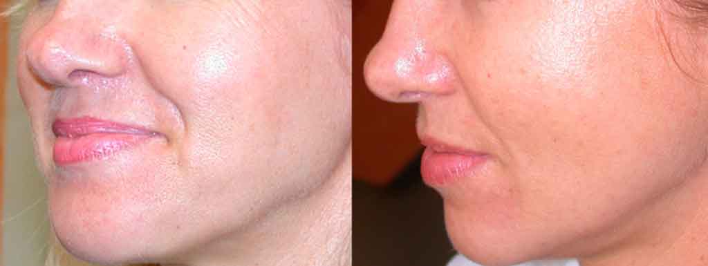 Microneedling Etobicoke