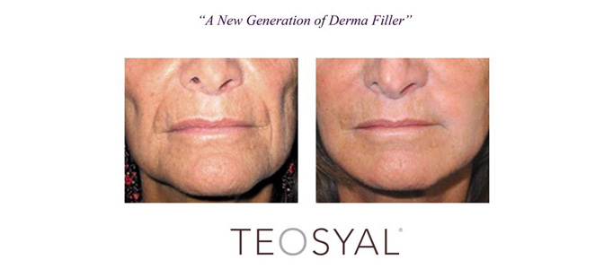 Microdermabrasion