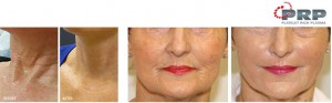 prp injections