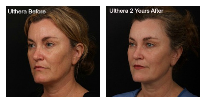 Is Ultherapy Only For The Face?