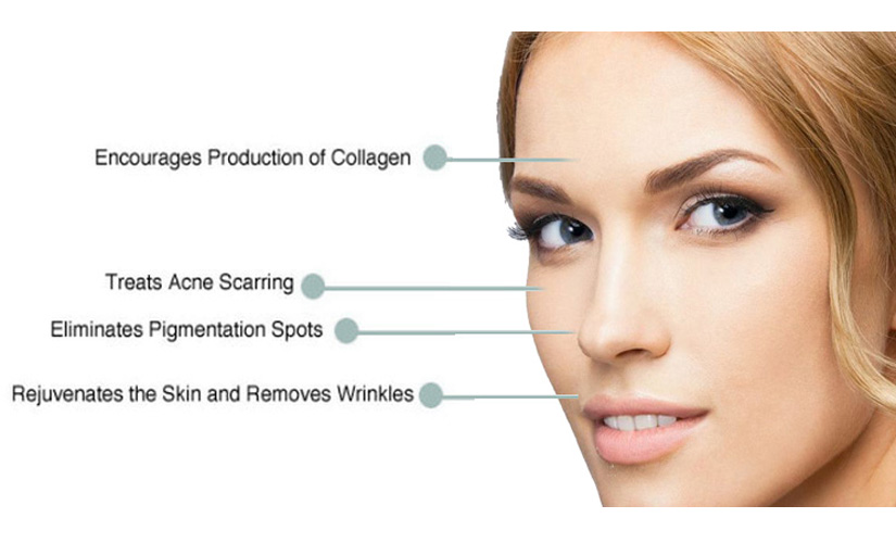 Micro Needling