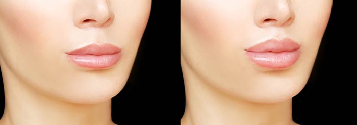Lip Augmentation
