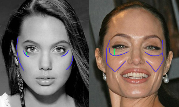 Dermal Fillers and Bone Loss