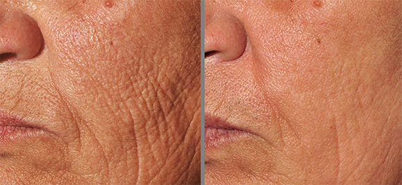 Micro Needling & Skin Tightening