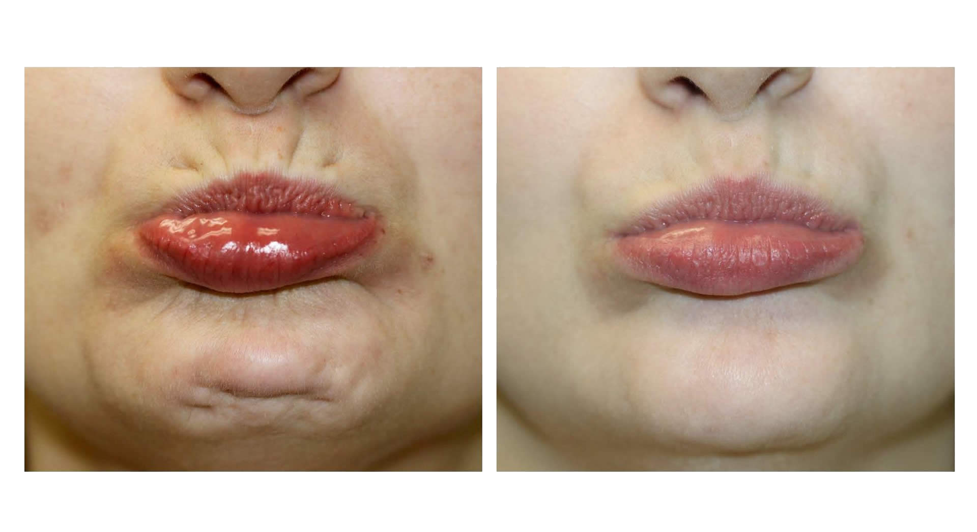 Botox For Your Chin