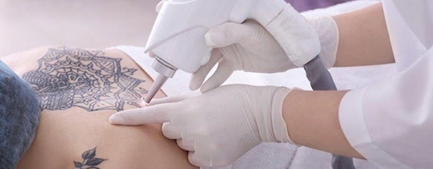 Laser Tattoo Removal Toronto