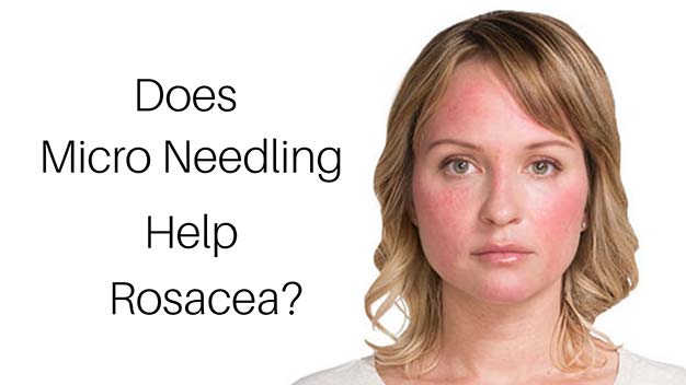 Does Micro needling Help Rosacea